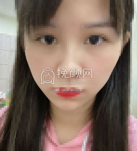 脸部皮肤松弛下垂做热玛吉会不会有果？