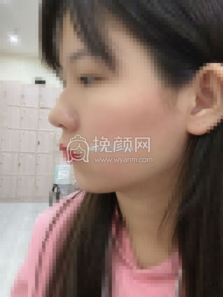 脸部皮肤松弛下垂做热玛吉会不会有果？