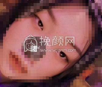 石家庄省二院赵雪莲平扇双眼皮+开眼角案例|果