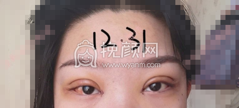 石家庄省二院赵雪莲平扇双眼皮+开眼角案例|果