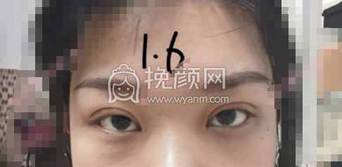 石家庄省二院赵雪莲平扇双眼皮+开眼角案例|果