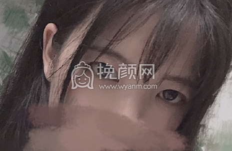 昆明稚嘉医美肖鸿双眼皮开眼角案例|果|价格