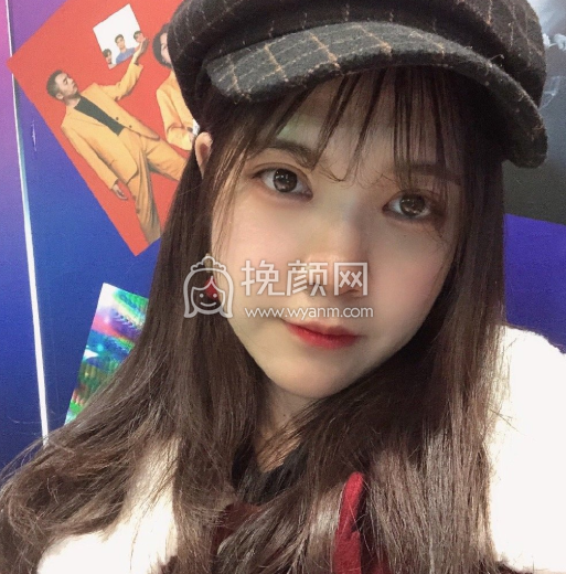 昆明稚嘉医美肖鸿双眼皮开眼角案例|果|价格