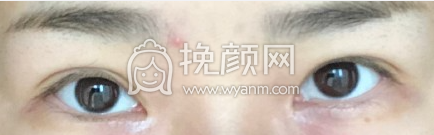成都三医院的叶飞轮双眼皮如何?