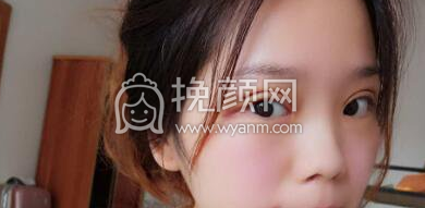 成都三医院的叶飞轮双眼皮如何?