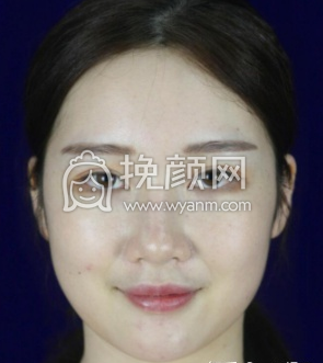 成都友谊李萍隆鼻怎么样啊?