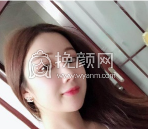 成都友谊李萍隆鼻怎么样啊?