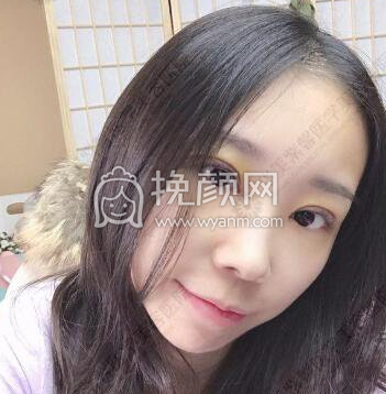 成都李正勇、徐敦、于晓波谁做双眼皮更好?|价