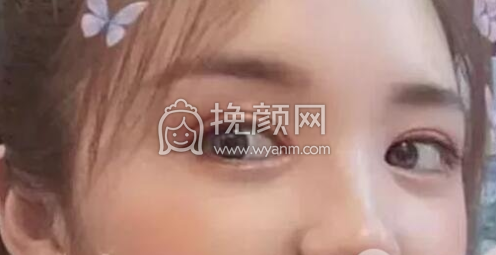 成都李正勇、徐敦、于晓波谁做双眼皮更好?|价
