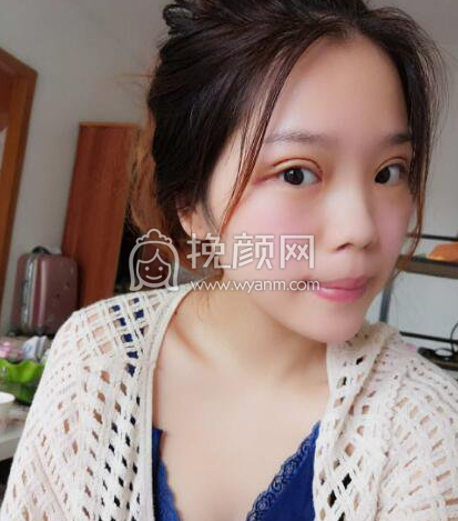 成都李正勇、徐敦、于晓波谁做双眼皮更好?|价