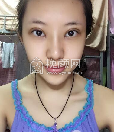 成都李正勇、徐敦、于晓波谁做双眼皮更好?|价