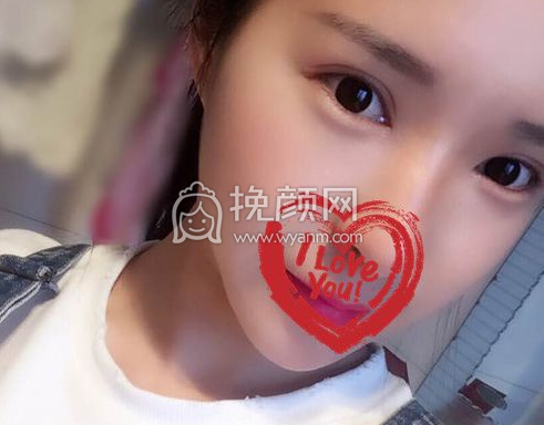 成都李正勇、徐敦、于晓波谁做双眼皮更好?|价