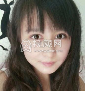 成都李正勇、徐敦、于晓波谁做双眼皮更好?|价