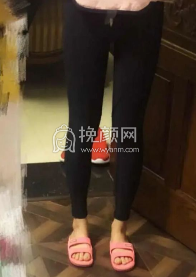 八大处整形医院陈博大小腿吸脂案例|果|价格