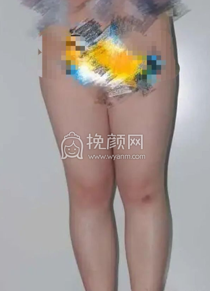 八大处整形医院陈博大小腿吸脂案例|果|价格