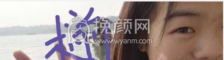 武汉协和医院郭亮双眼皮+开内眼角案例|果|价