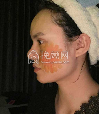 鼻基底和下颌角手术有什么风险吗?膨体和曼特