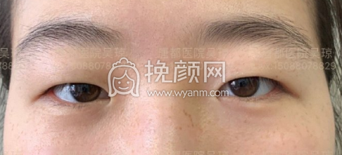 西安第一医院吴琼双眼皮+开眼角案例|果|价格