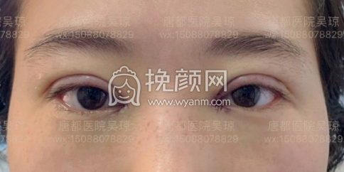 西安第一医院吴琼双眼皮+开眼角案例|果|价格