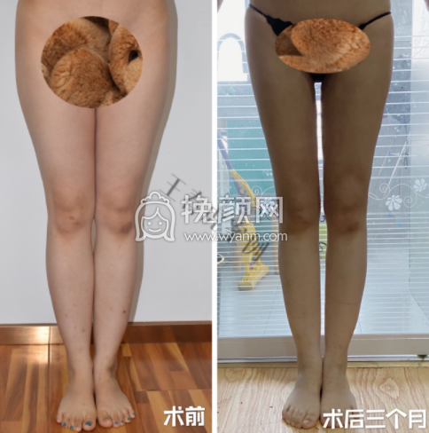 八大处整形医院王春虎大小腿吸脂案例|果|价格