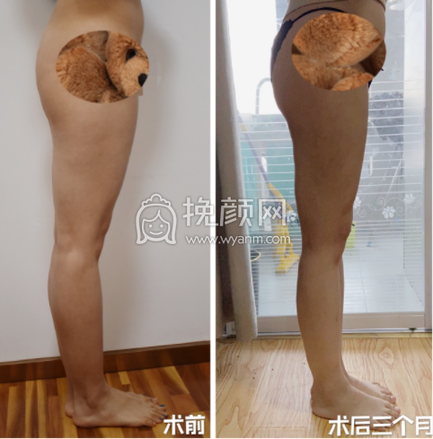 八大处整形医院王春虎大小腿吸脂案例|果|价格