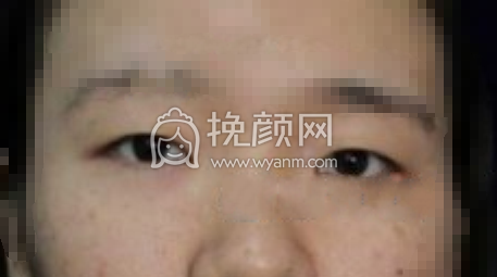 长沙欣颜靳海涛切开重睑+內眦赘皮矫正案例|果
