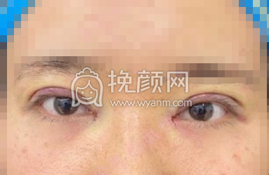 长沙欣颜靳海涛切开重睑+內眦赘皮矫正案例|果