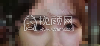 长沙欣颜靳海涛切开重睑+內眦赘皮矫正案例|果