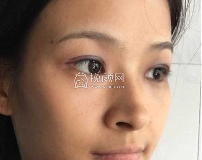 滕州人民医院孟繁君做双眼皮果怎么样?