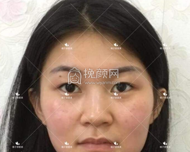 包头华美戴主任割双眼皮怎么样?