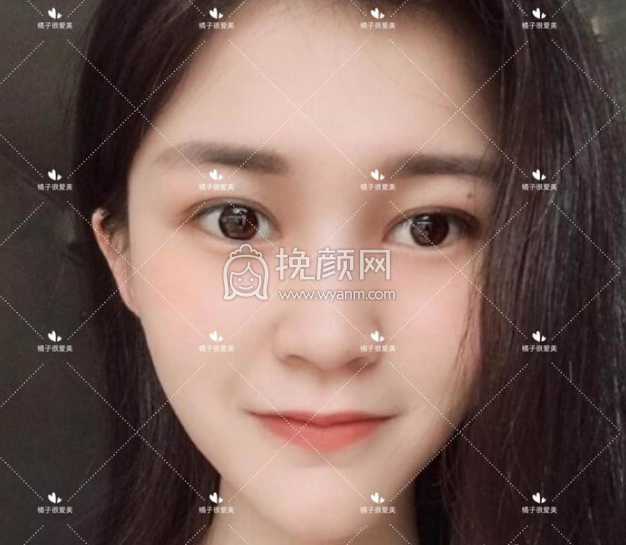 包头华美戴主任割双眼皮怎么样?