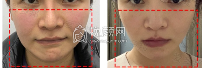 北京爱多邦黎星医生抽脂技术怎么样?