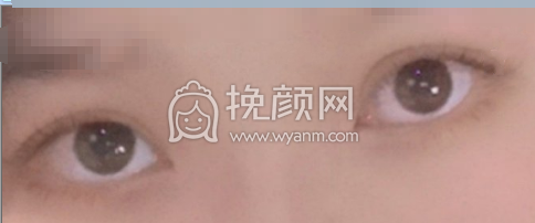 武汉同济医学院陈平全切双眼皮果|案例|价格