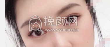 西安第一医院吴琼微创双眼皮案例|果|价格