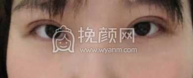深圳博美医院王红玮双眼皮提肌开眼角案例|果