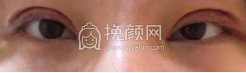 深圳博美医院王红玮双眼皮提肌开眼角案例|果