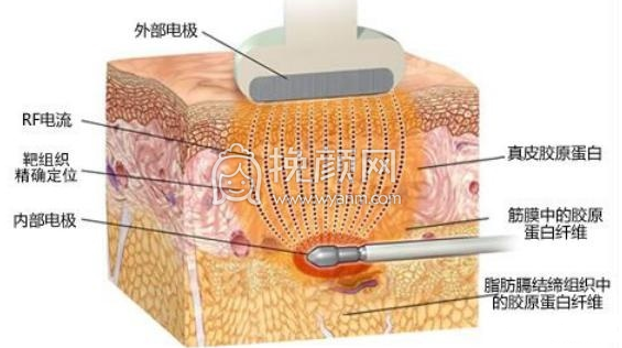 5G光雕吸脂技术有什么风险?果怎么样?
