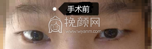 石家庄馨悦张卓男全切双眼皮手术案例|果|价格
