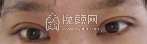 石家庄馨悦张卓男全切双眼皮手术案例|果|价格
