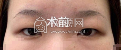 海华山医院周兆平双眼皮全切去皮去脂价格|果