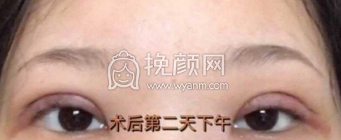 海华山医院周兆平双眼皮全切去皮去脂价格|果
