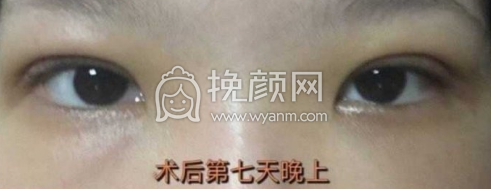 海华山医院周兆平双眼皮全切去皮去脂价格|果