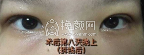 海华山医院周兆平双眼皮全切去皮去脂价格|果