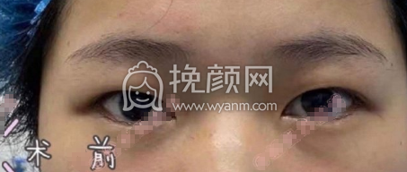 广药附一徐媛医生全切双眼皮+开眼角案例|果
