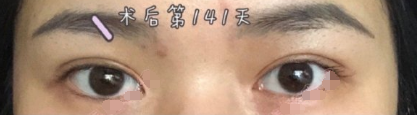 广药附一徐媛医生全切双眼皮+开眼角案例|果