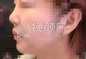 上海映九医疗门诊李诚桓异体骨隆鼻部手术+硅胶垫