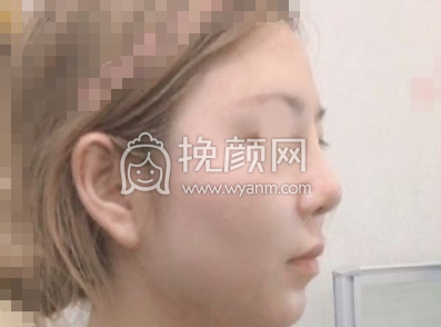上海映九医疗门诊李诚桓异体骨隆鼻部手术+硅胶垫