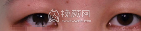 上海九院李海洲全切双眼皮开眼角案例|果|价格