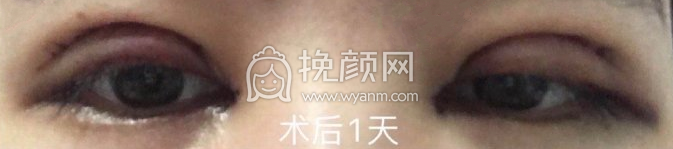 上海九院李海洲全切双眼皮开眼角案例|果|价格