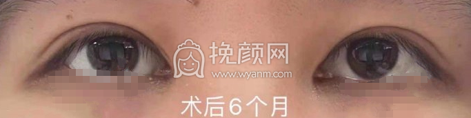 上海九院李海洲全切双眼皮开眼角案例|果|价格